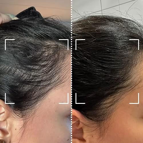 Avant/après traitement anti-chute Hair Nova Pro™ – résultats sur 2 semaines