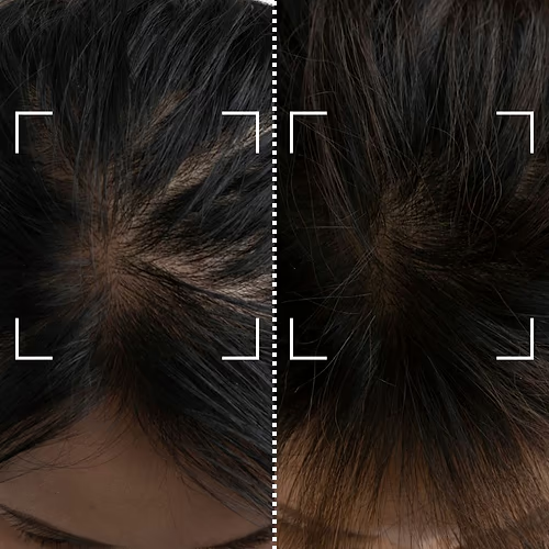 Avant/après traitement anti-chute Hair Nova Pro™ – résultats sur 2 semaines
