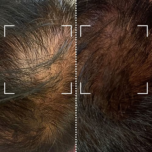 Avant/après traitement anti-chute Hair Nova Pro™ – résultats sur 2 semaines